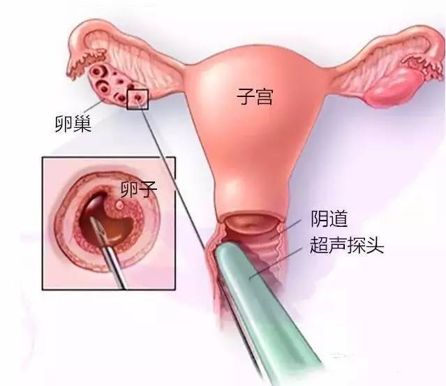 总结了广州助孕流程取卵后的出血事宜