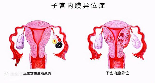 试管婴儿可以解决哪些生育障碍问题？