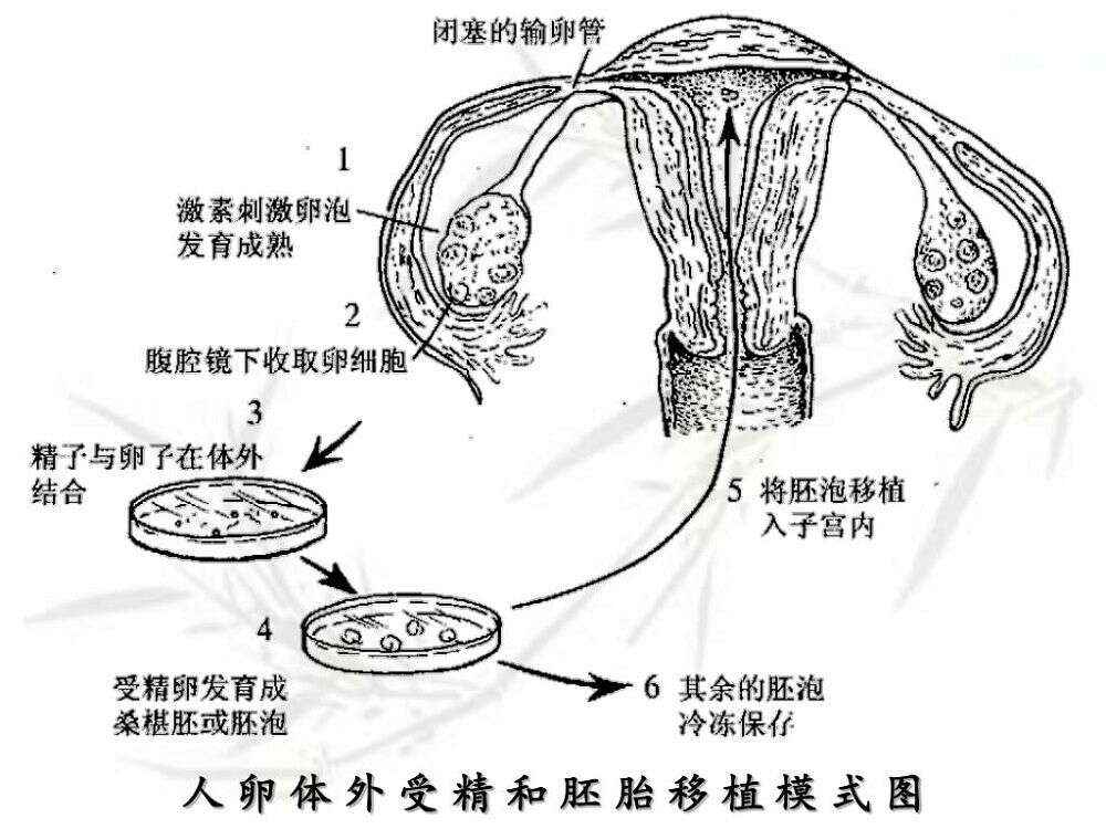 试管婴儿第一、二、三代技术的差异