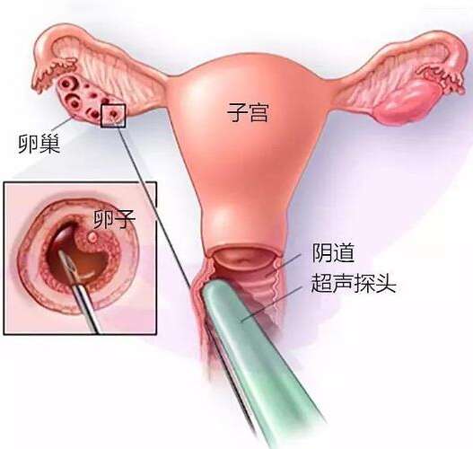 第三代试管婴儿（PGD）