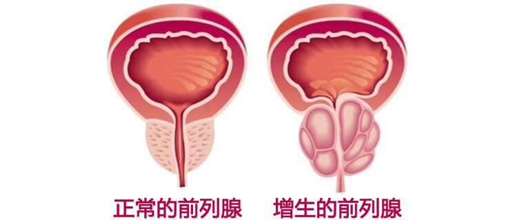 前列腺增生
