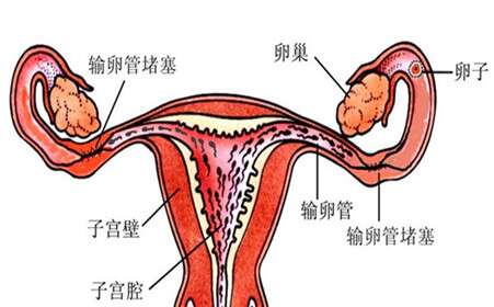 输卵管炎对广州助孕代妈生育的影响