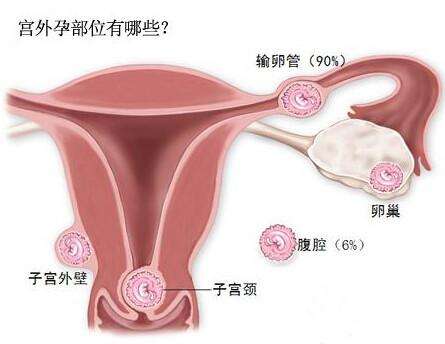 试管婴儿技术会不会有宫外孕的风险